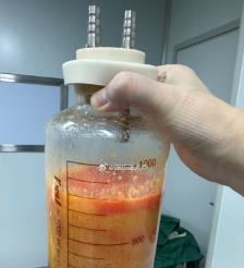 天津水动力吸脂手术要做多久？